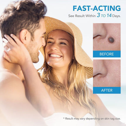 Auto Micro Skin Tag Remover Device Kit, Painless Removal 2-8mm