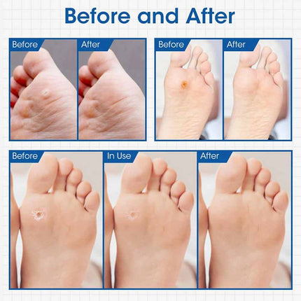 24pcs Gentle Corn Pads for Toes, Callus Removal Adhesive Pads for Feet