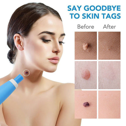 Auto Micro Skin Tag Remover Device Kit, Painless Removal 2-8mm