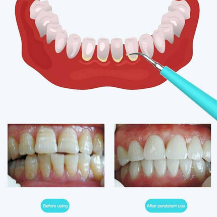 Portable Electric Dental Scaler Tool for Plaque, Tartar & Stains