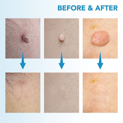Auto Micro Skin Tag Remover Device Kit, Painless Removal 2-8mm